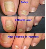 1409389318583_nail-fungus-contagious.jpg