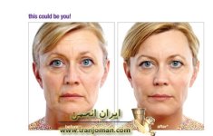 botox_juvederm_voluma_aesthetic_Solutions.jpg